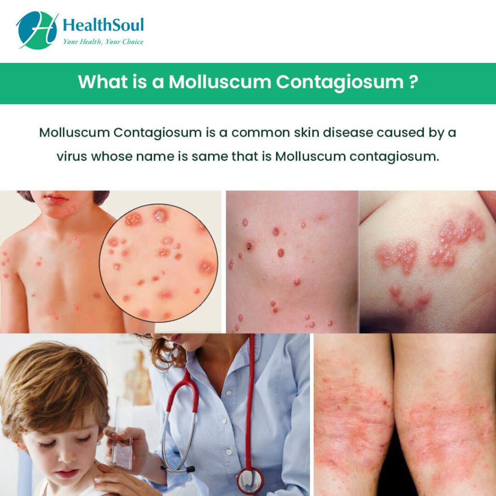 Molluscum Contagiosum Community Health Systems Of Wisconsin